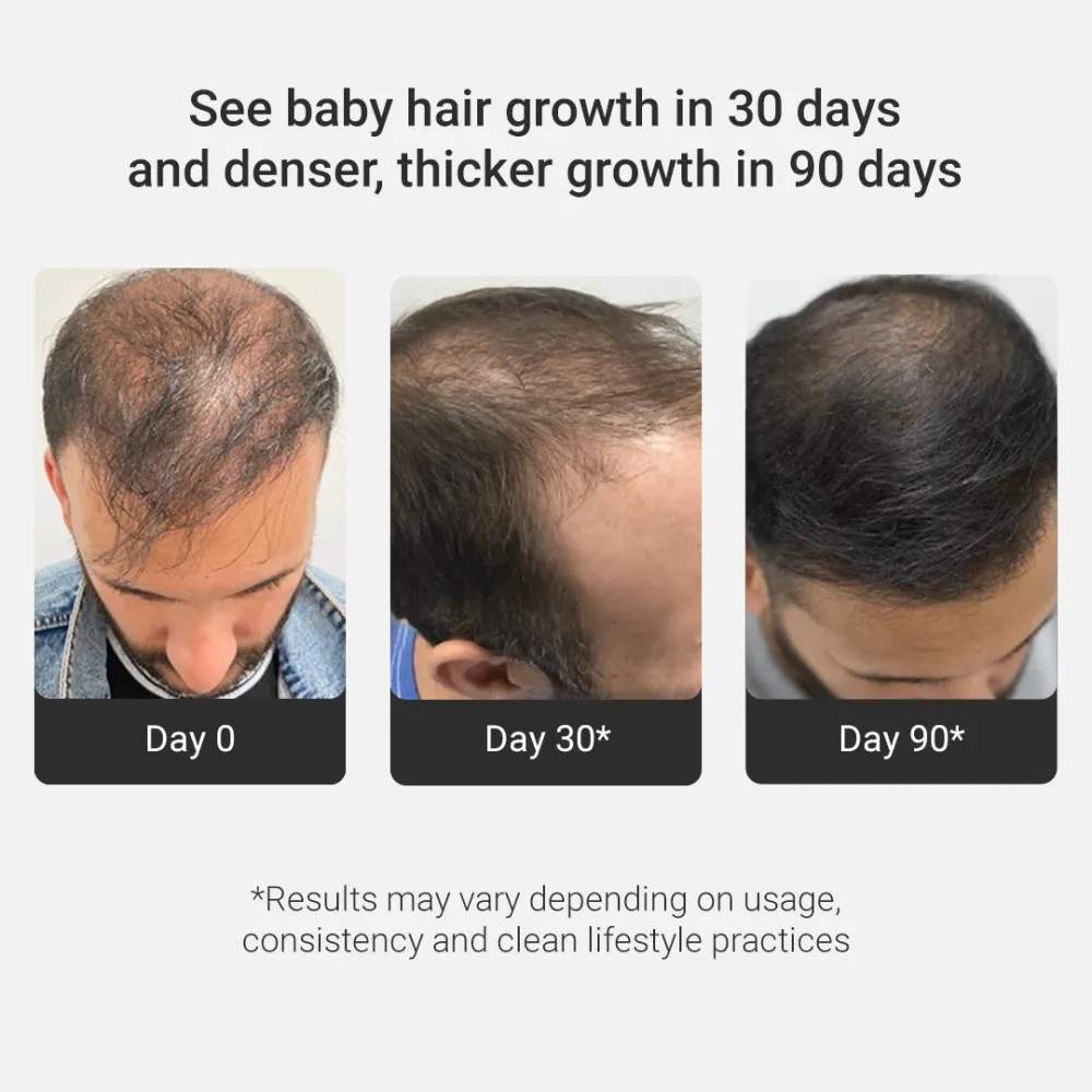 Grow Strong Combo - Super Shampoo 300ml + Serum 30ml - Free Derma Roller + Scalp Massager - Image 5